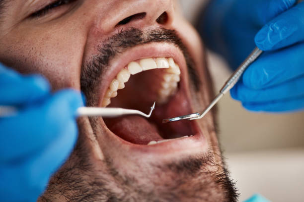Best Emergency Dental Care for Broken or Chipped Teeth in Maurice, LA