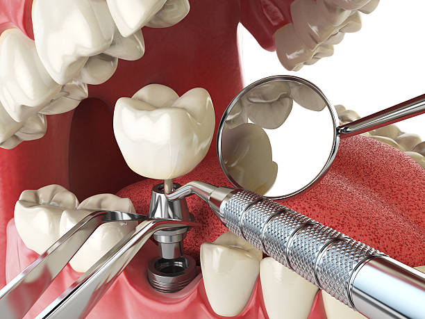 Best Emergency Tooth Extraction in Maurice, LA